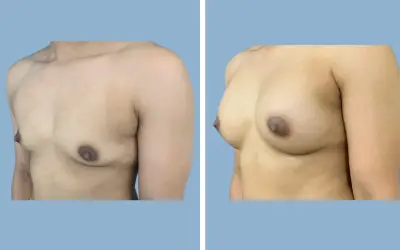 Before and After